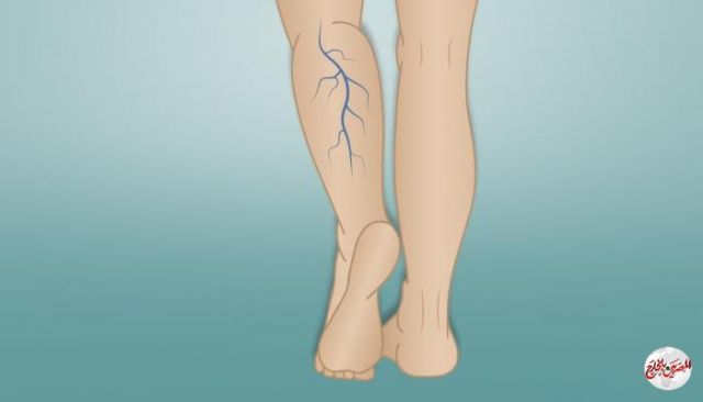 تعرف على 10 خطوات تعالج دوالي الساقين