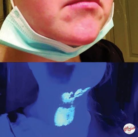 ارتداء نصف الكمامة يسمح بدخول الفيروس للجسم بسهولة