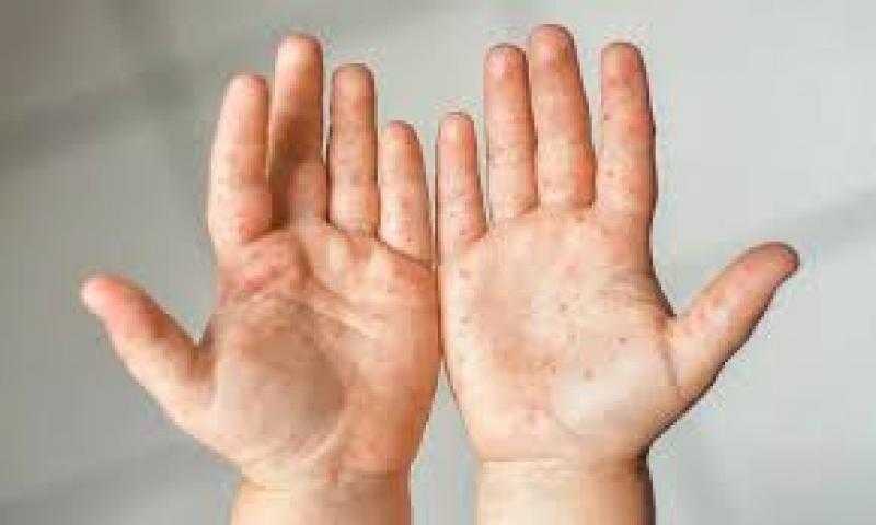 متحدث ”الصحة” يطمئن أولياء الأمور بالمدارس بعدم وجود خطورة من مرض ”اليد والفم والقدم”