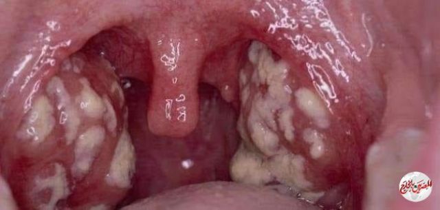 معلومة طبية.. التهاب اللوز